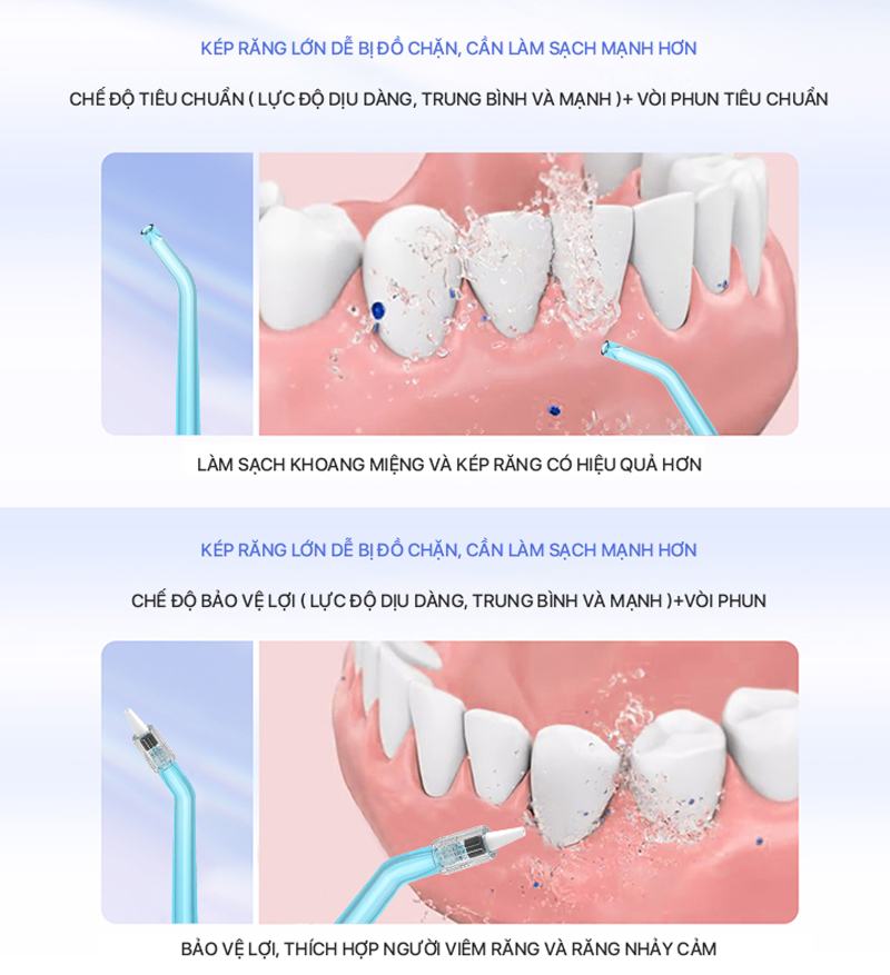 Làm sạch kẽ răng, túi nha chu, bề mặt răng hiệu quả